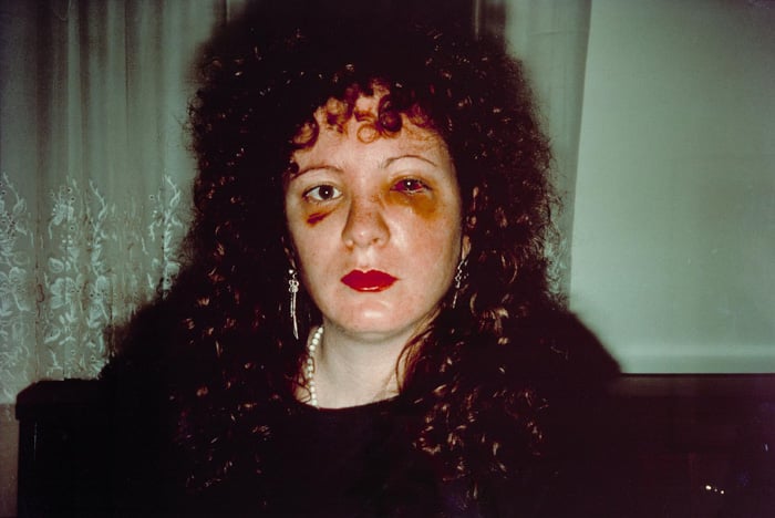 Nan one month after being battered - Nan Goldin (1984) - controversial photos