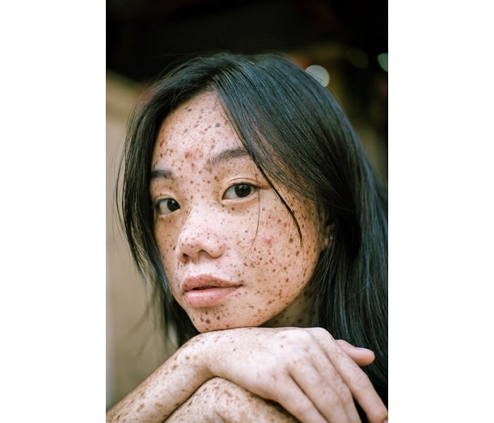 Portrait of young woman with freckles and spots
